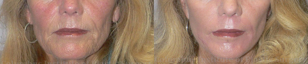 Phenol Chemical Peel before and after photo by Columbus Institute of Plastic Surgery in Columbus, OH