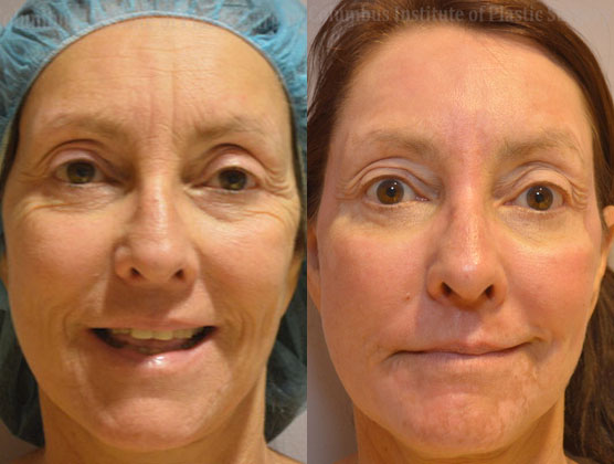 Phenol Chemical Peel before and after photo by Columbus Institute of Plastic Surgery in Columbus, OH