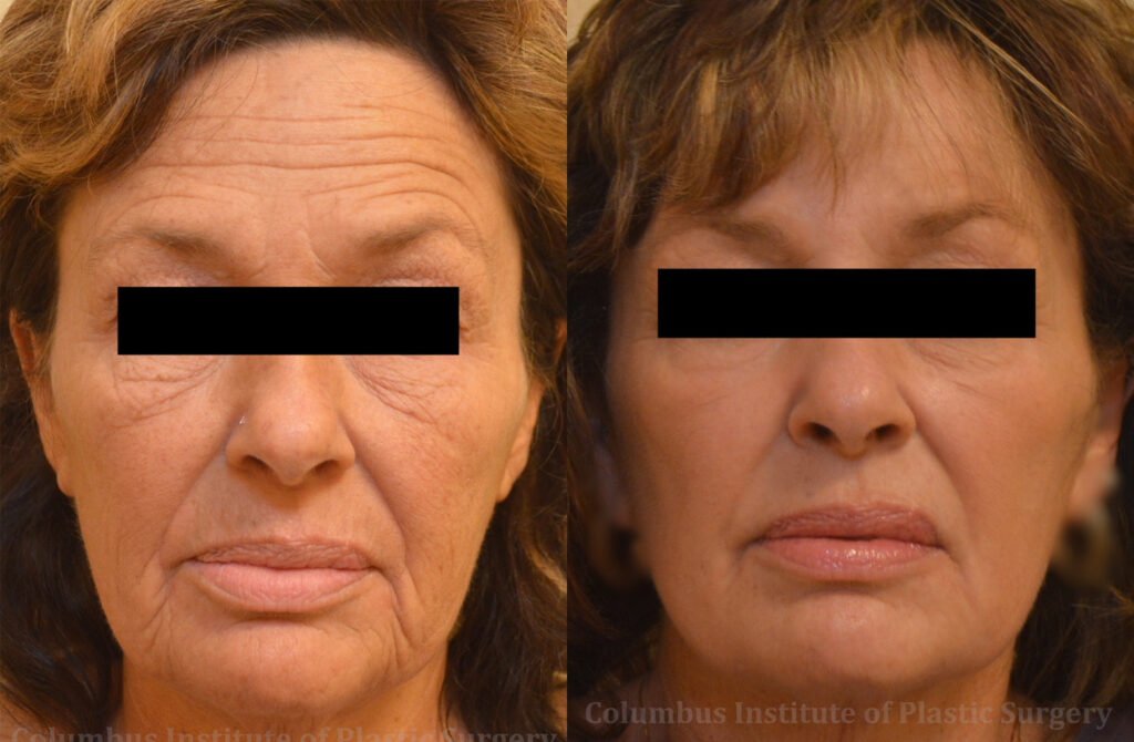 Phenol Chemical Peel before and after photo by Columbus Institute of Plastic Surgery in Columbus, OH