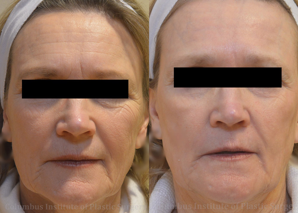 Phenol Chemical Peel before and after photo by Columbus Institute of Plastic Surgery in Columbus, OH