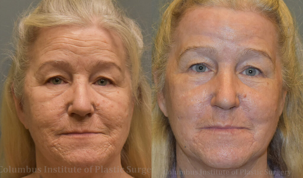 Phenol Chemical Peel before and after photo by Columbus Institute of Plastic Surgery in Columbus, OH