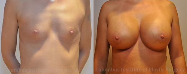 Breast Augmentation before and after photo by Columbus Institute of Plastic Surgery in Columbus, OH