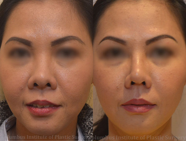 Rhinoplasty/Septoplasty before and after photo by Columbus Institute of Plastic Surgery in Columbus, OH