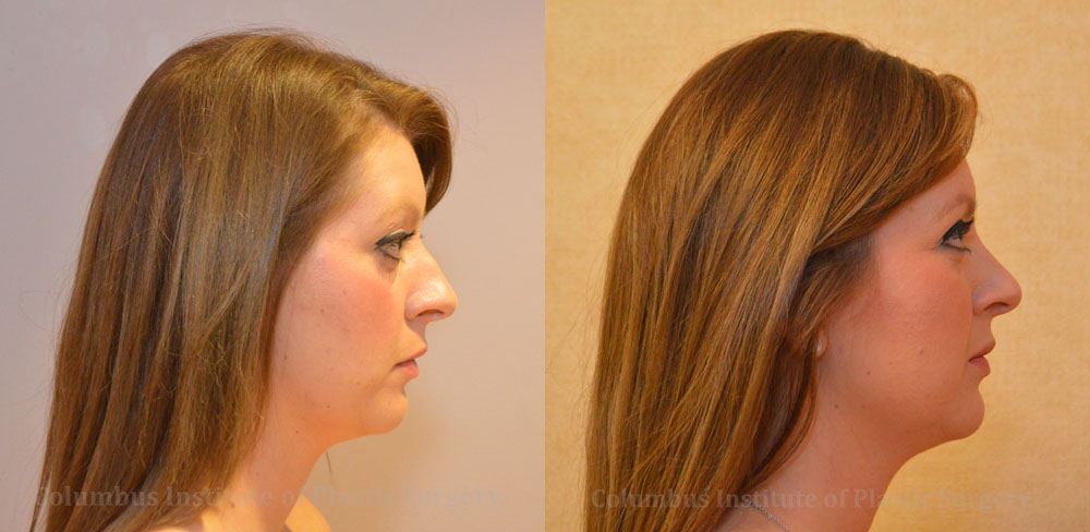 Rhinoplasty/Septoplasty before and after photo by Columbus Institute of Plastic Surgery in Columbus, OH