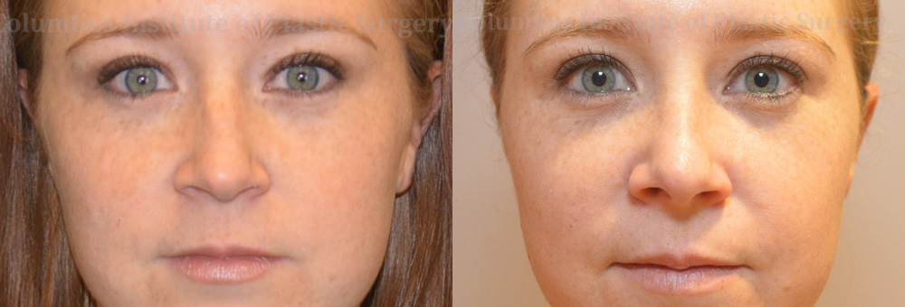 Rhinoplasty/Septoplasty before and after photo by Columbus Institute of Plastic Surgery in Columbus, OH