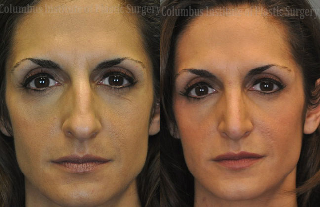 Rhinoplasty/Septoplasty before and after photo by Columbus Institute of Plastic Surgery in Columbus, OH