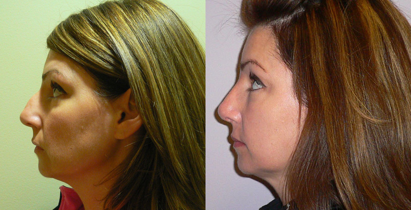 Rhinoplasty/Septoplasty before and after photo by Columbus Institute of Plastic Surgery in Columbus, OH