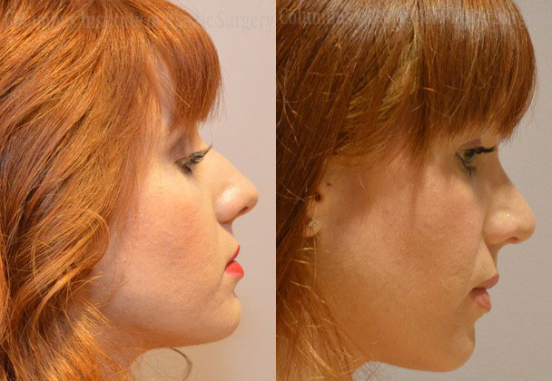 Rhinoplasty/Septoplasty before and after photo by Columbus Institute of Plastic Surgery in Columbus, OH