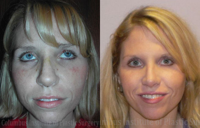 Rhinoplasty/Septoplasty before and after photo by Columbus Institute of Plastic Surgery in Columbus, OH