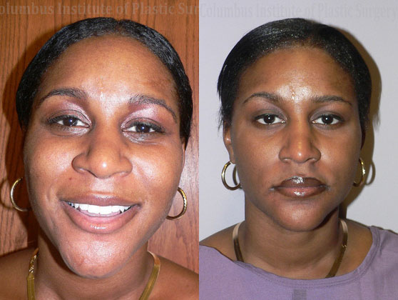 Rhinoplasty/Septoplasty before and after photo by Columbus Institute of Plastic Surgery in Columbus, OH