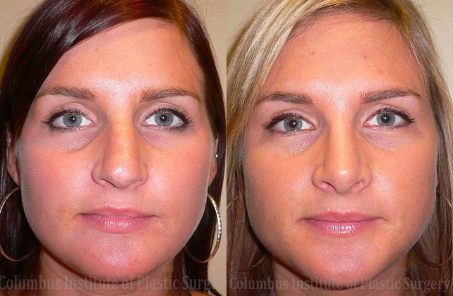 Rhinoplasty/Septoplasty before and after photo by Columbus Institute of Plastic Surgery in Columbus, OH