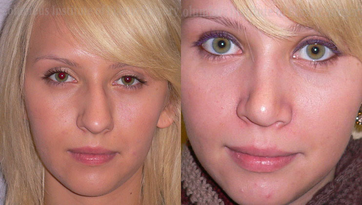 Rhinoplasty/Septoplasty before and after photo by Columbus Institute of Plastic Surgery in Columbus, OH
