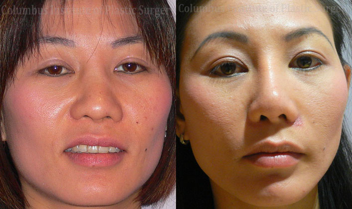 Rhinoplasty/Septoplasty before and after photo by Columbus Institute of Plastic Surgery in Columbus, OH