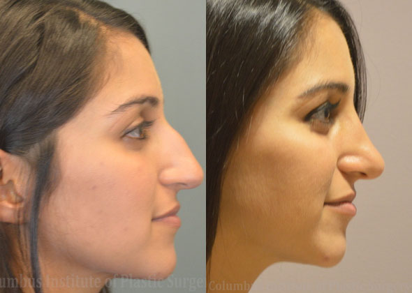 Rhinoplasty/Septoplasty before and after photo by Columbus Institute of Plastic Surgery in Columbus, OH