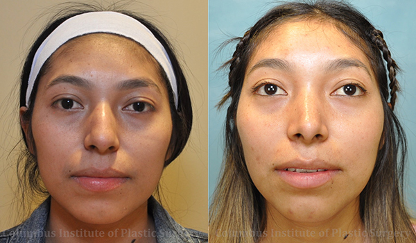Rhinoplasty/Septoplasty before and after photo by Columbus Institute of Plastic Surgery in Columbus, OH