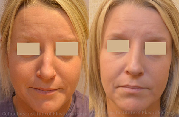 Rhinoplasty/Septoplasty before and after photo by Columbus Institute of Plastic Surgery in Columbus, OH