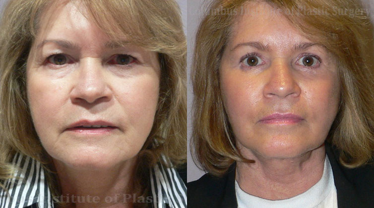 Surgical Facial Rejuvenation before and after photo by Columbus Institute of Plastic Surgery in Columbus, OH
