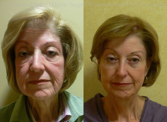 Surgical Facial Rejuvenation before and after photo by Columbus Institute of Plastic Surgery in Columbus, OH