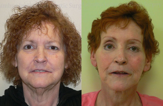 Surgical Facial Rejuvenation before and after photo by Columbus Institute of Plastic Surgery in Columbus, OH