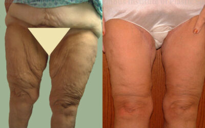 Thighplasty (Thigh Lift) before and after photo by Columbus Institute of Plastic Surgery in Columbus, OH Thighplasty (Thigh Lift) before and after photo by Columbus Institute of Plastic Surgery in Columbus, OH
