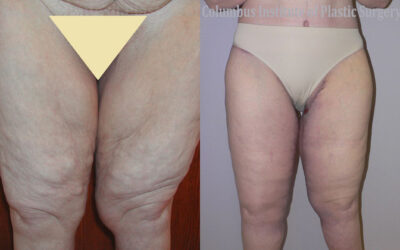 Thighplasty (Thigh Lift) before and after photo by Columbus Institute of Plastic Surgery in Columbus, OH Thighplasty (Thigh Lift) before and after photo by Columbus Institute of Plastic Surgery in Columbus, OH