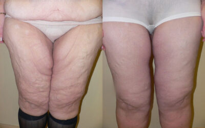 Thighplasty (Thigh Lift) before and after photo by Columbus Institute of Plastic Surgery in Columbus, OH Thighplasty (Thigh Lift) before and after photo by Columbus Institute of Plastic Surgery in Columbus, OH