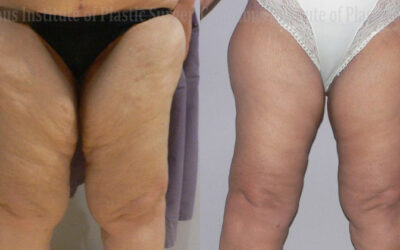 Thighplasty (Thigh Lift) before and after photo by Columbus Institute of Plastic Surgery in Columbus, OH Thighplasty (Thigh Lift) before and after photo by Columbus Institute of Plastic Surgery in Columbus, OH