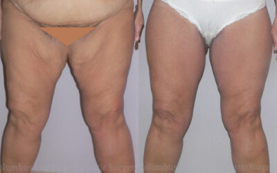 Thighplasty (Thigh Lift) before and after photo by Columbus Institute of Plastic Surgery in Columbus, OH Thighplasty (Thigh Lift) before and after photo by Columbus Institute of Plastic Surgery in Columbus, OH