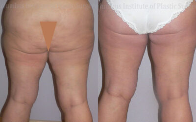 Thighplasty (Thigh Lift) before and after photo by Columbus Institute of Plastic Surgery in Columbus, OH Thighplasty (Thigh Lift) before and after photo by Columbus Institute of Plastic Surgery in Columbus, OH