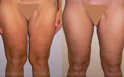 Thighplasty (Thigh Lift) before and after photo by Columbus Institute of Plastic Surgery in Columbus, OH Thighplasty (Thigh Lift) before and after photo by Columbus Institute of Plastic Surgery in Columbus, OH