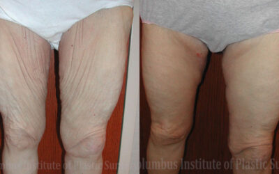 Thighplasty (Thigh Lift) before and after photo by Columbus Institute of Plastic Surgery in Columbus, OH Thighplasty (Thigh Lift) before and after photo by Columbus Institute of Plastic Surgery in Columbus, OH