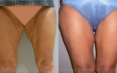 Thighplasty (Thigh Lift) before and after photo by Columbus Institute of Plastic Surgery in Columbus, OH Thighplasty (Thigh Lift) before and after photo by Columbus Institute of Plastic Surgery in Columbus, OH
