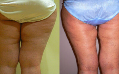 Thighplasty (Thigh Lift) before and after photo by Columbus Institute of Plastic Surgery in Columbus, OH Thighplasty (Thigh Lift) before and after photo by Columbus Institute of Plastic Surgery in Columbus, OH