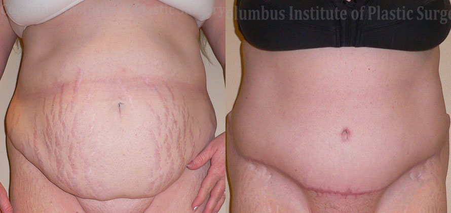 Abdominoplasty (Tummy Tuck) before and after photo by Columbus Institute of Plastic Surgery in Columbus, OH