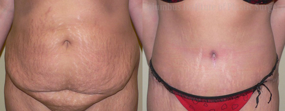 Abdominoplasty (Tummy Tuck) before and after photo by Columbus Institute of Plastic Surgery in Columbus, OH