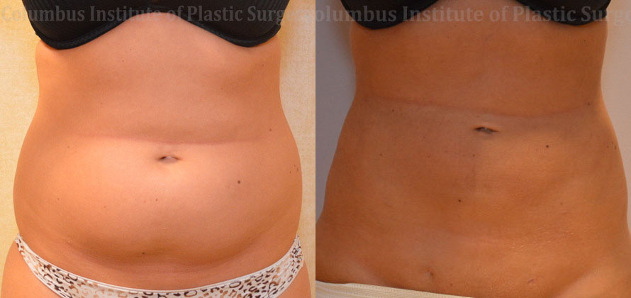 Liposuction before and after photo by Columbus Institute of Plastic Surgery in Columbus, OH