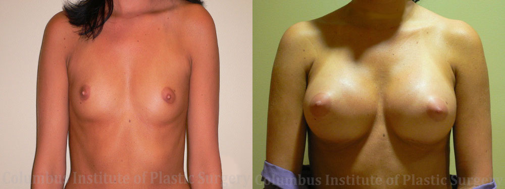 Breast Augmentation – 300cc-400cc before and after photo by Columbus Institute of Plastic Surgery in Columbus, OH
