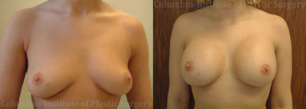 Breast Augmentation – 300cc-400cc before and after photo by Columbus Institute of Plastic Surgery in Columbus, OH