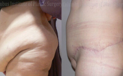 Belt Lipectomy before and after photo by Columbus Institute of Plastic Surgery in Columbus, OH Belt Lipectomy before and after photo by Columbus Institute of Plastic Surgery in Columbus, OH