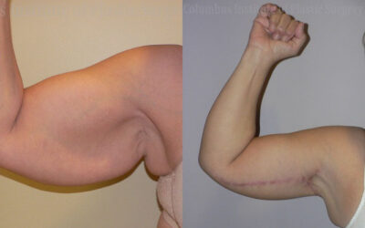 Brachioplasty (Arm Lift) before and after photo by Columbus Institute of Plastic Surgery in Columbus, OH Brachioplasty (Arm Lift) before and after photo by Columbus Institute of Plastic Surgery in Columbus, OH