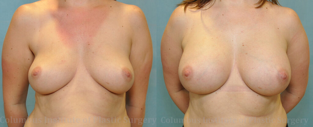 Breast Augmentation – 300cc-400cc before and after photo by Columbus Institute of Plastic Surgery in Columbus, OH