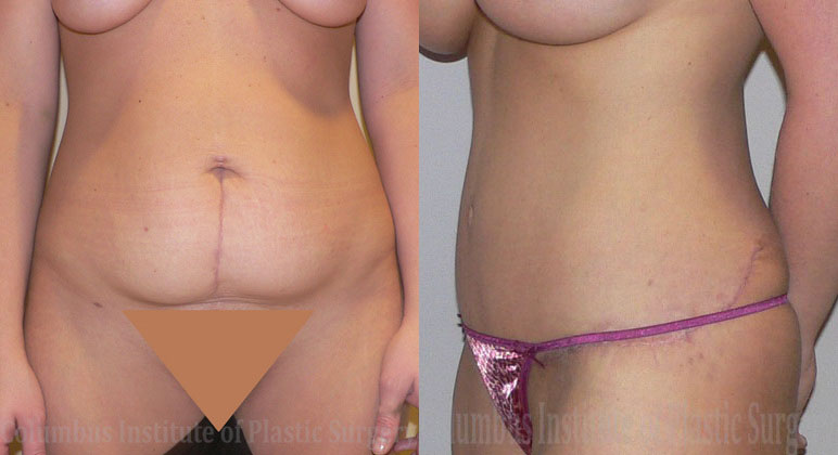 Abdominoplasty (Tummy Tuck) before and after photo by Columbus Institute of Plastic Surgery in Columbus, OH