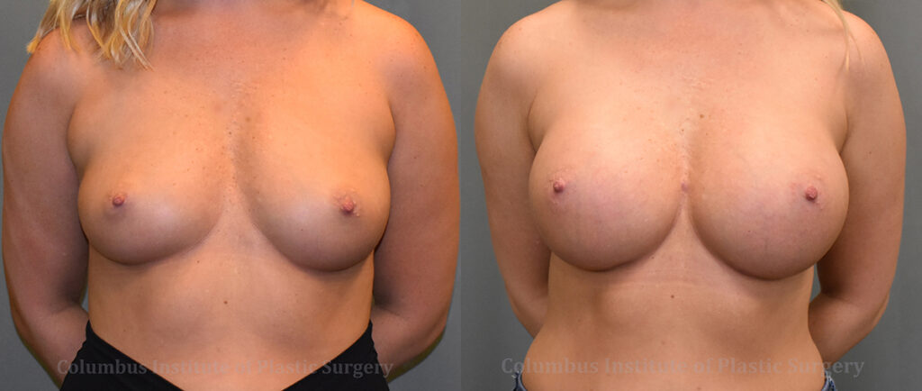 Breast Augmentation – 400cc-500cc before and after photo by Columbus Institute of Plastic Surgery in Columbus, OH