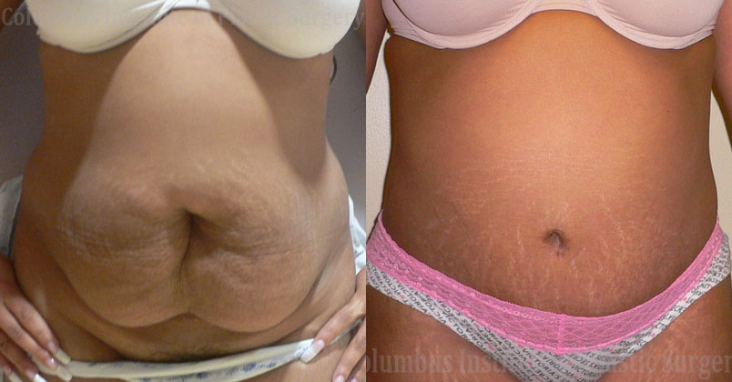 Abdominoplasty (Tummy Tuck) before and after photo by Columbus Institute of Plastic Surgery in Columbus, OH