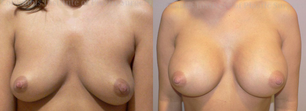 Breast Augmentation – 300cc-400cc before and after photo by Columbus Institute of Plastic Surgery in Columbus, OH