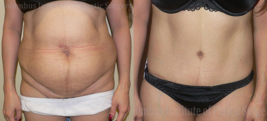 Abdominoplasty (Tummy Tuck) before and after photo by Columbus Institute of Plastic Surgery in Columbus, OH