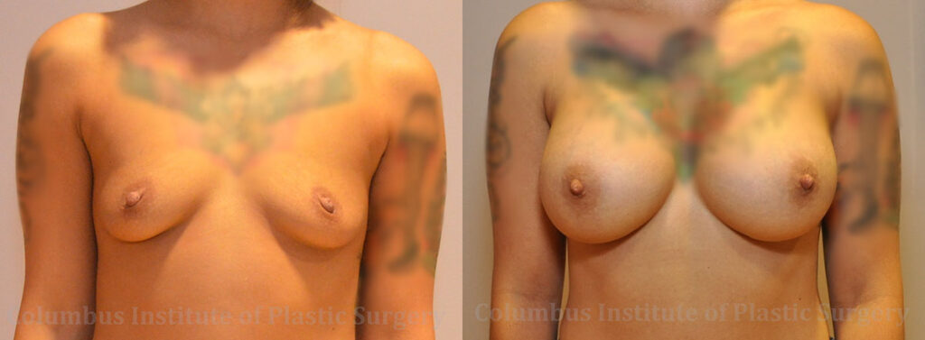 Breast Augmentation before and after photo by Columbus Institute of Plastic Surgery in Columbus, OH