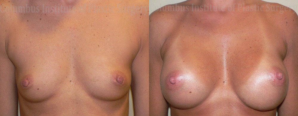 Breast Augmentation before and after photo by Columbus Institute of Plastic Surgery in Columbus, OH