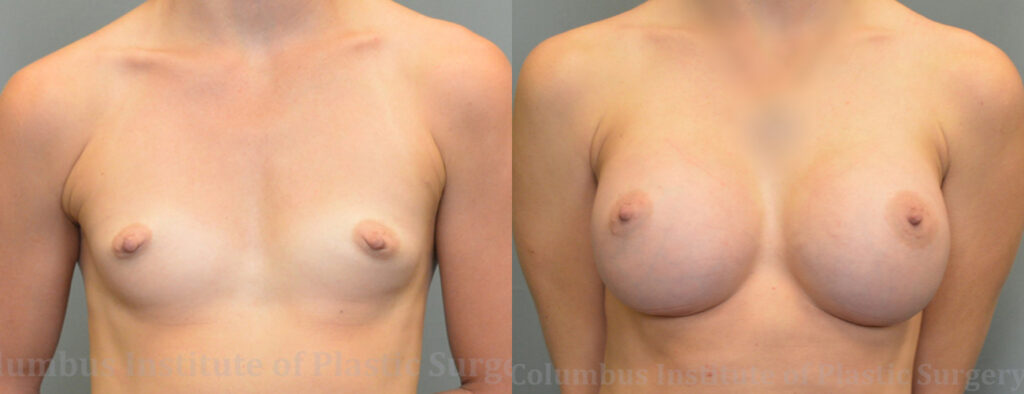 Breast Augmentation – 400cc-500cc before and after photo by Columbus Institute of Plastic Surgery in Columbus, OH
