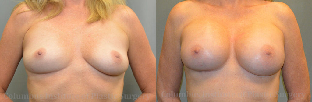 Breast Augmentation before and after photo by Columbus Institute of Plastic Surgery in Columbus, OH